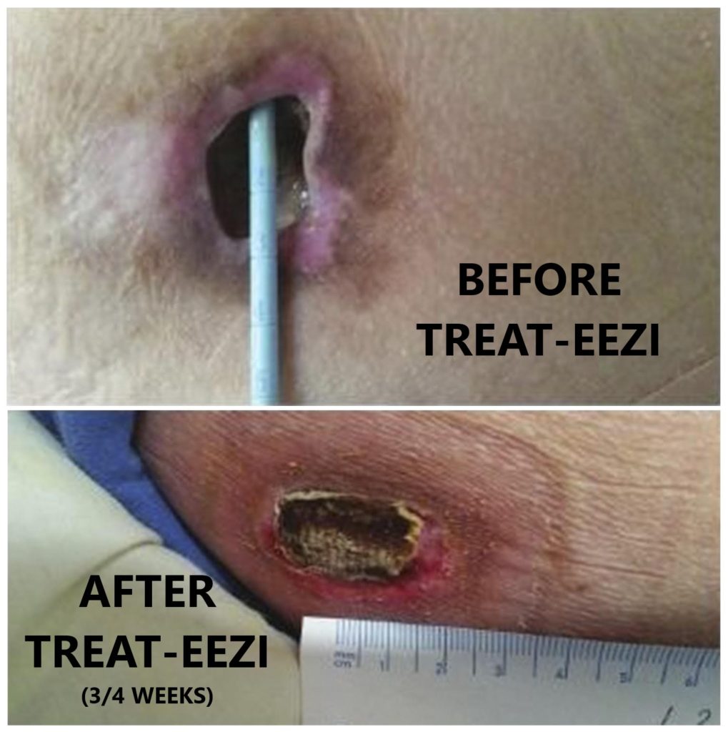 Treat-Eezi has undergone rigorous clinical trials to evaluate its efficiency in preventing and healing pressure sores. These studies have demonstrated significant reductions in both the incidence and severity of pressure sores among patients using Treat-Eezi compared to other support surfaces. The results validate Treat-Eezi's effectiveness in improving patient outcomes and enhancing quality of life by healing pressure sores and preventing their progression.