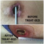 Wounds before and after Treat Eezi