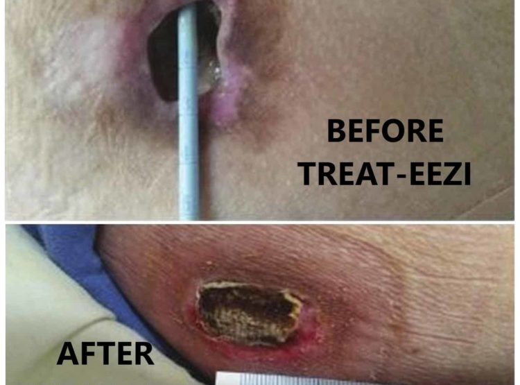 Wounds before and after Treat Eezi